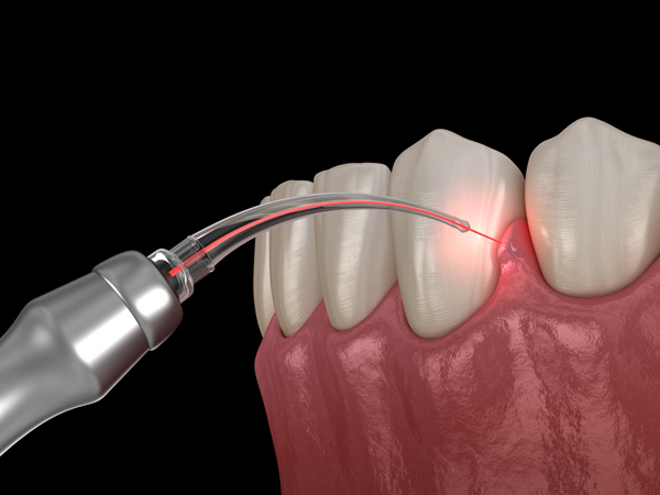 peridontal procedure